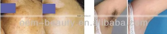 Medical CE IPL hair removal machine pigment acne treatment