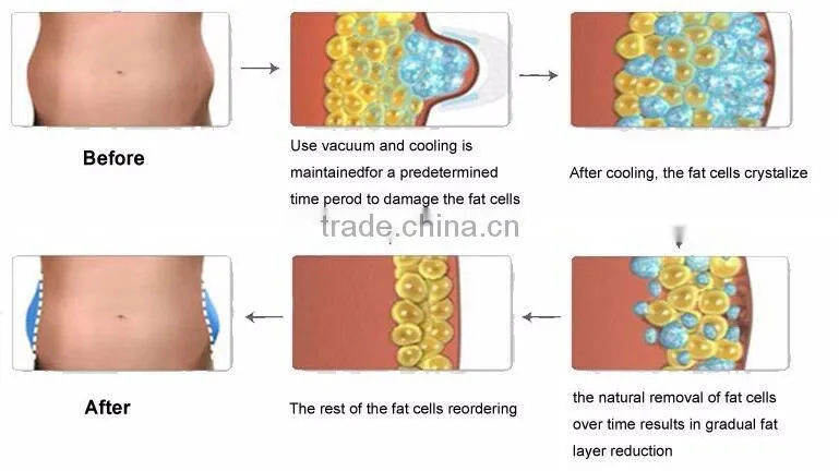 Top Sale 2016 Non-invasive Cryolipolyse Minceur Machine For Fat Cellulite