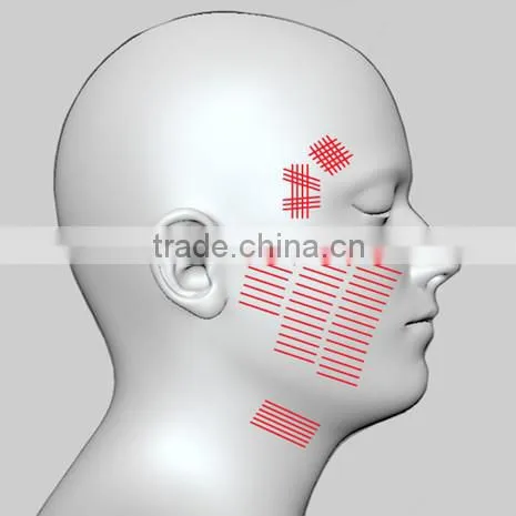 CE Certificated HIFU portable machine/korea/body/face lift Belle-HIFUhifu high intensity focused ultrasound