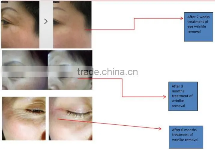 eye care machine for eye wrinkle removal, eye bag removal