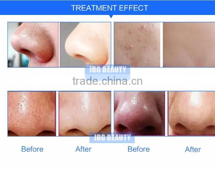 Hot sale diamond dermabrasion oxygen water jet aqua diamond peel machine