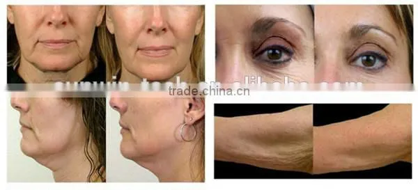 SW-007B 2014 New design home use rf skin tightening face lifting machine