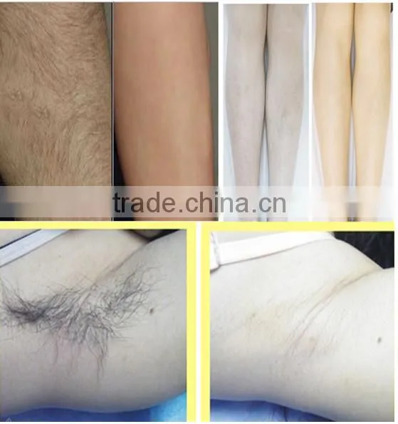 ipl laser hair removal for body leg