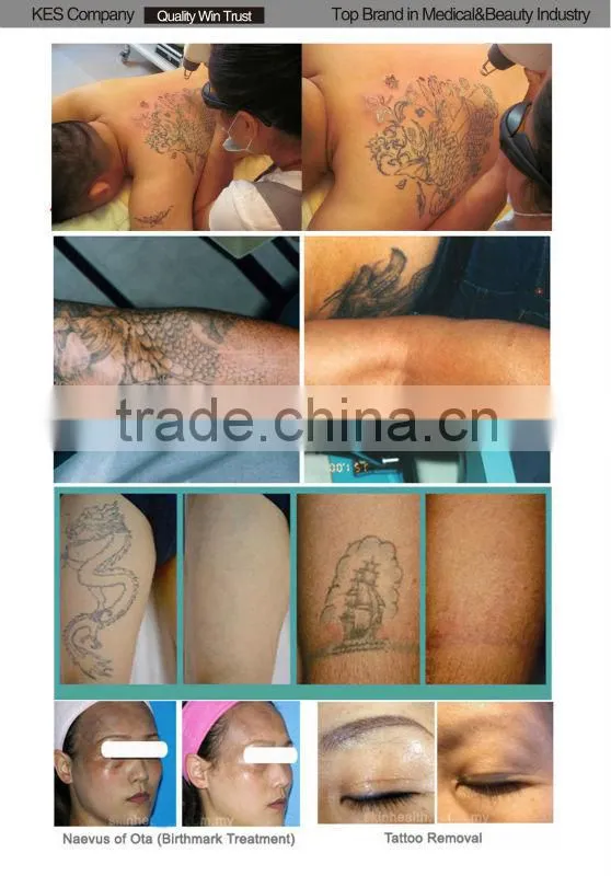 Med-800 2015 hot sell yag laser freckle removal beauty machine tattoo color enhancer