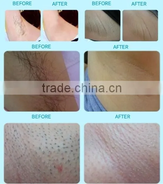 CE Certificated permanent hair removal SHR OPT IPL permanent hair removal laser in alibaba