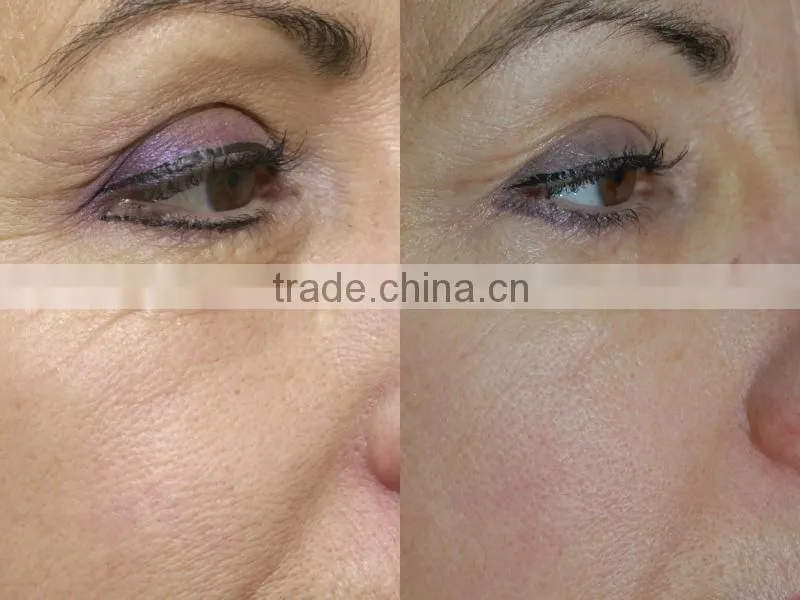 radio frequency face lifting machine
