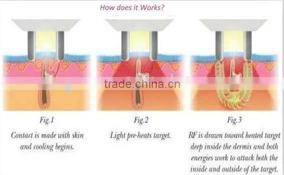 Special hot selling alexandrite hair removal