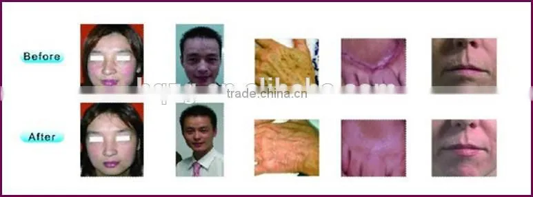 beauty machine scar removal scar treatment co2 for wholesales