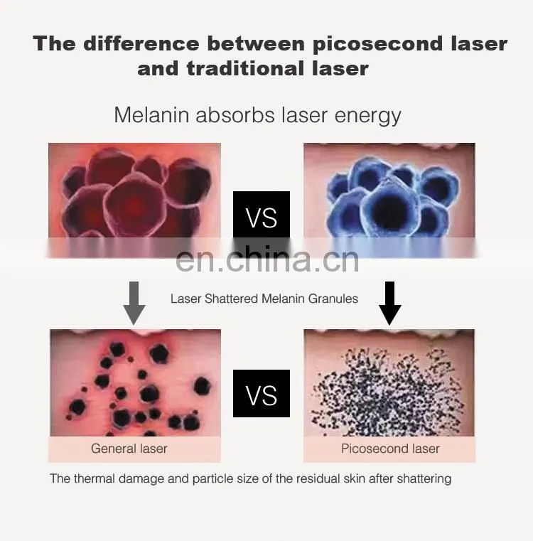 Big Sale Picosecond Laser Birthmark/Tattoo Removal Machine with Powerful Energy