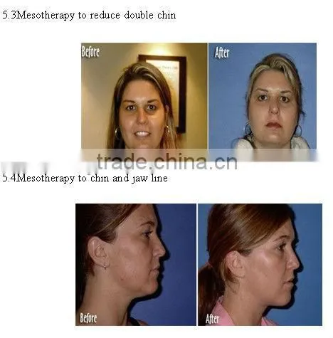 mesotherapy needle medical injection device with CE approval
