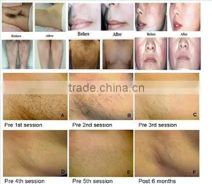 Professional beauty Equipment IPL 2015 RF laser hair removal system