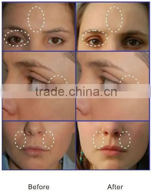 Best thermagic lift fractional rf facial lift beauty equipement