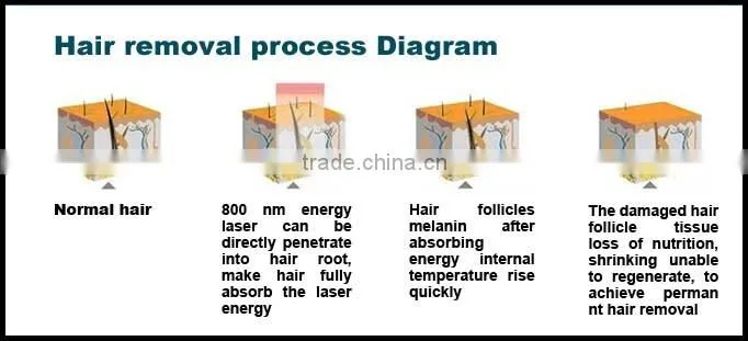 Medspa needed ipl diode laser hair removal machine with price