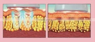 Mini 32 Khz Cavitation & LED RF Beauty Equipment(LipaWay)