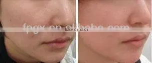 IPL Skin Rejuvenation And Hair Removal Beauty Machine