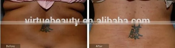 Portable Lipo Laser for fat removal equipment home use