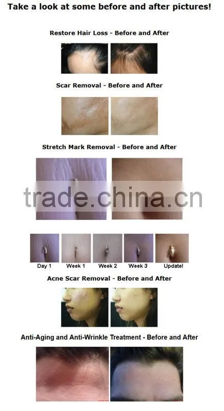 2013-2017 the most professional +powerful 540 derma rejuvenate