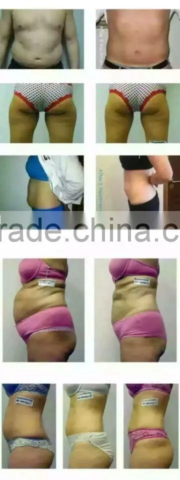 Professional Face Lift Hifu Ultra Slimming Machine With Liposonix