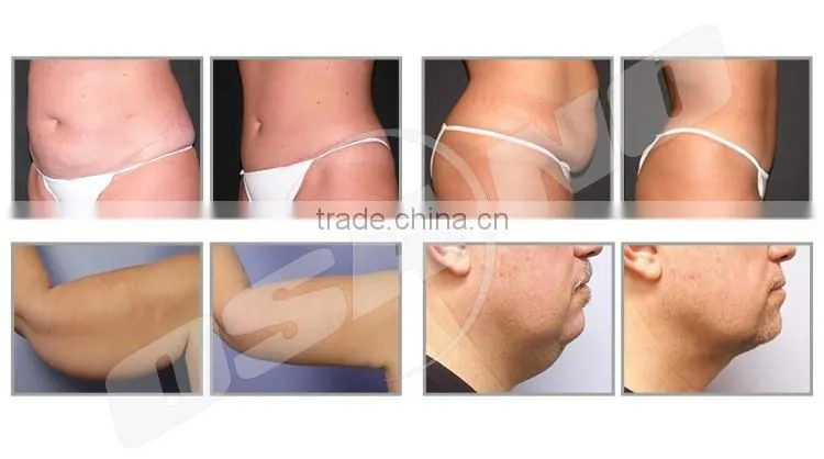 Best lipo laser machine , portable lipolaser slimming machine