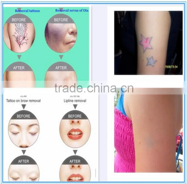 Shipping free portable q-switched laser price