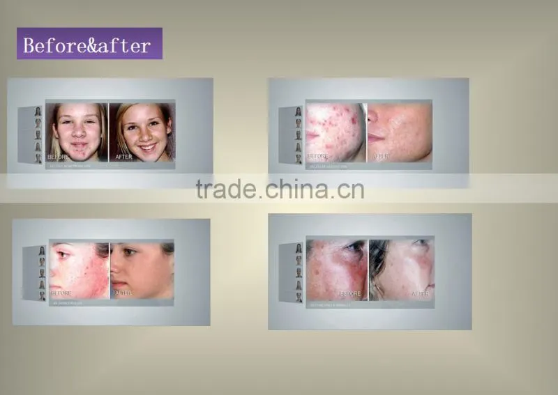 Beijing Virtue Beauty Silk peel machine/ Water silk peel machine