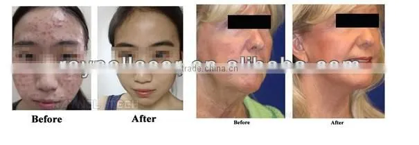 Hot Selling in USA Mini Red/Blue Light Machine For Skin Care, Skin Tighten, Acne Treatment/LED Light Therapy Machine