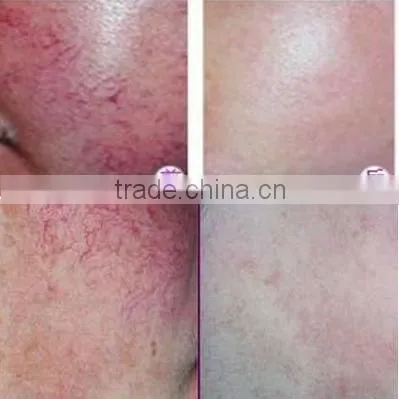aimed middle & high-ended market! 30MHz radio high frequency skin care