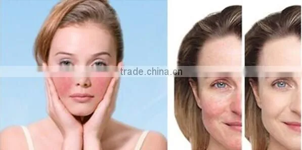 980nm vascular laser removal diode laser 980nm