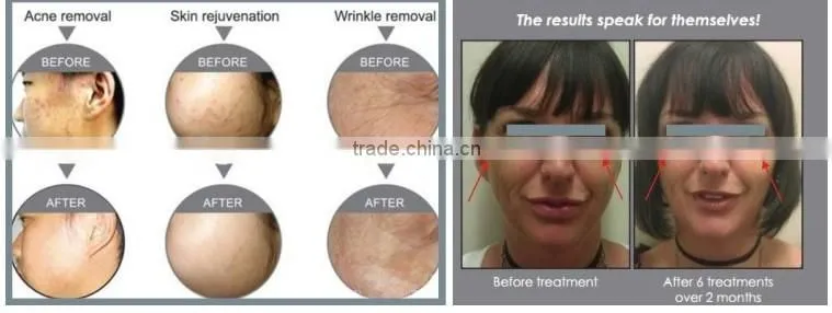 PDT Led Machine/ Led Light Pdt Skin Rejuvenation Beauty Machine/ Fda Led Light