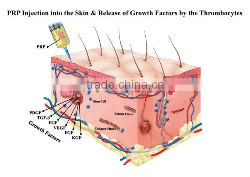 Pyrogen free ACD additive PRP tube for platelet rich plasma treatment