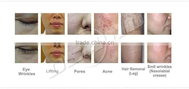 Worldwide Distributors Wanted IPL Hair Loss Treatment For Men With IPL Filter Machine Price