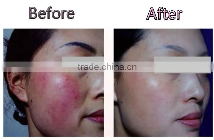 2014 New design RBS high frequency vascular removal machine