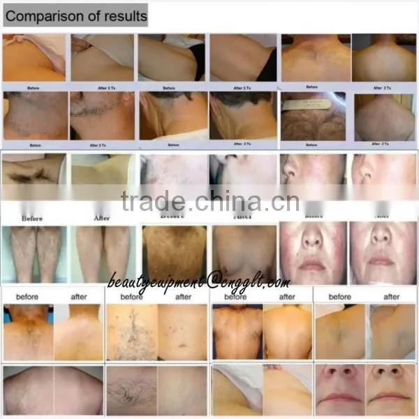 Lumenis Lightsheer Diode Laser