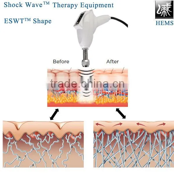 Shockwave ESWT Slimming And Beauty Machines-ESWT Shape