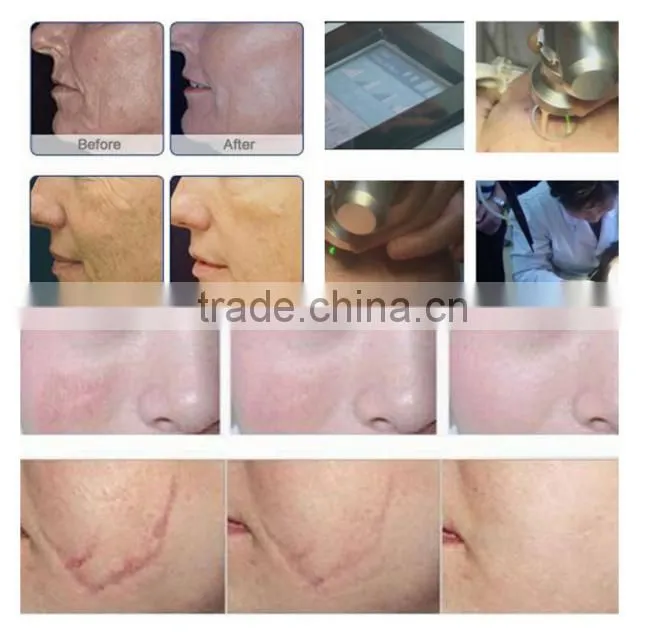 Hot Sell China RF Tube fractional co2 laser/rf co2 fractional laser/USA RF Tube fractional co2/Co2 Fractional Laser