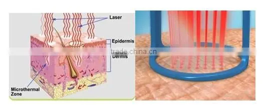 vaginal rejuvenation laser fractional co2 gynecology therapy machine