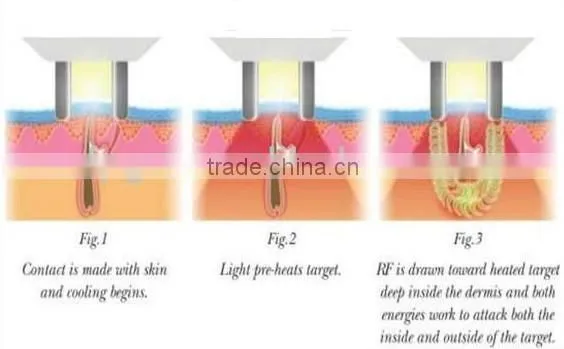Elight ipl shr cooling rf +epidermis cooling hair removal machine