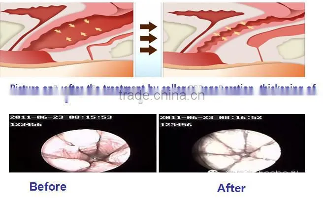 RF tube Co2 fractional laser scar removal gynecology laser viginal tightening machine