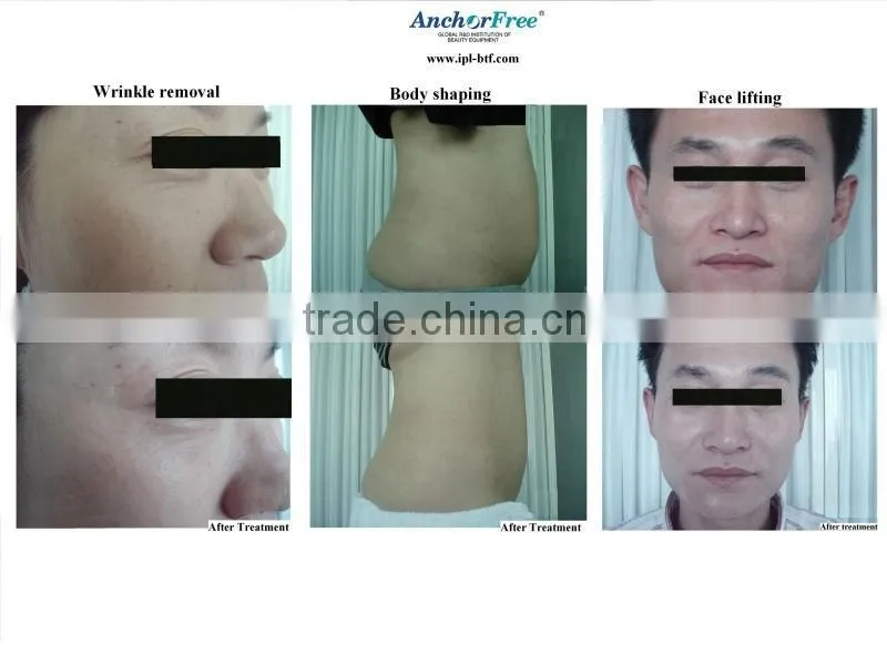 rf laser cavitation body shape beauty machine
