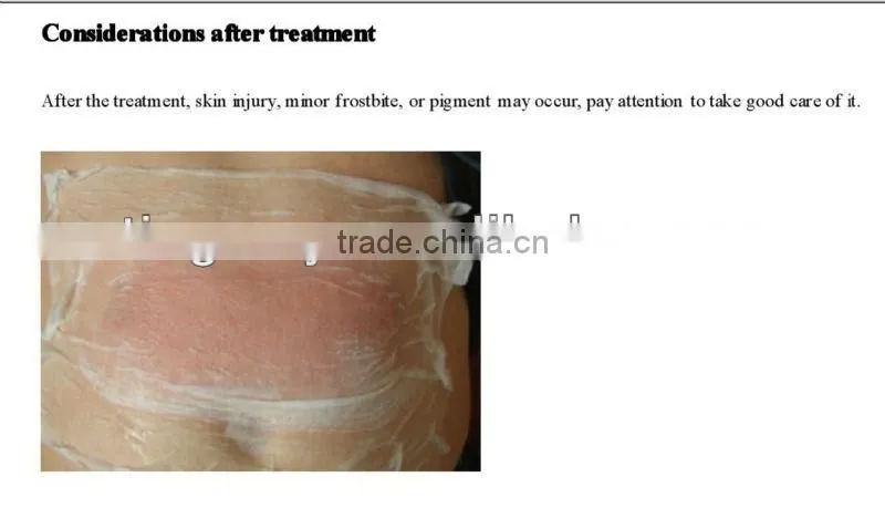 Vertical Cryolipolysis machine therapy venus cryolipolysis fat freezing machine
