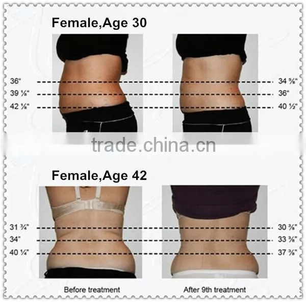 Hot sale lipolaser slimming
