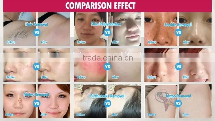 Best opt laser multifunction beauty equipment