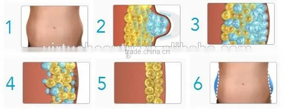 Cryo fat removal cryo of lipolysis slimming machine
