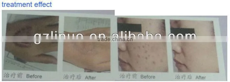 rf radio frequency bipolar radio frequency(wrinkle removal quickly!!!!)
