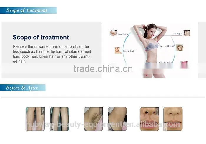 2015 new design Back Hair Removal/Beauty Salon Hair Removal/Brazilian Laser Hair Removal