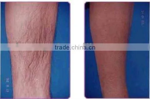 Hottest portable ipl with skin rejuvenation and rf face lifting treatment
