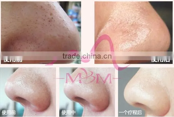 3 Steps BlackHead Cleansing Mask Black Head Removal Best Suction Blackhead