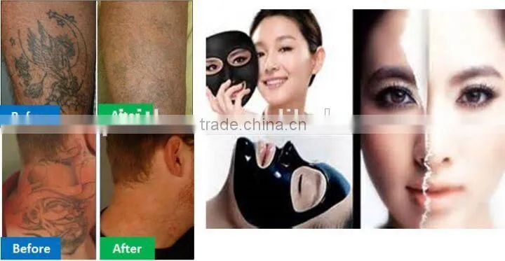 Super shr hair removal machine with nd yag laser system
