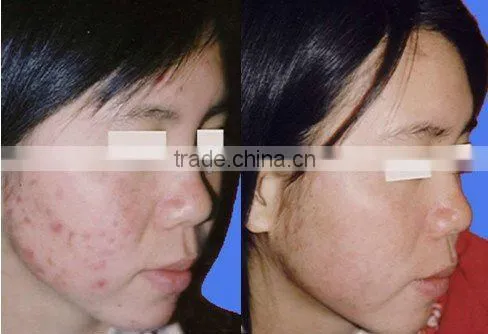 Fractional photoepilation! ipl+rf elight machine for hair removal C006