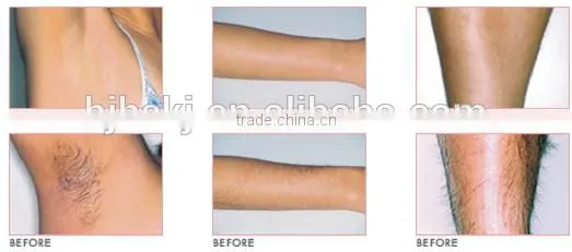 2015 new speediness professional laser hair removal equipment ipl
